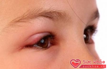 Mắt bị sưng là một trong những dấu hiệu hiệu đau mắt đỏ