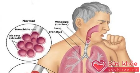 Một số biểu hiện của bệnh ung thư phổi