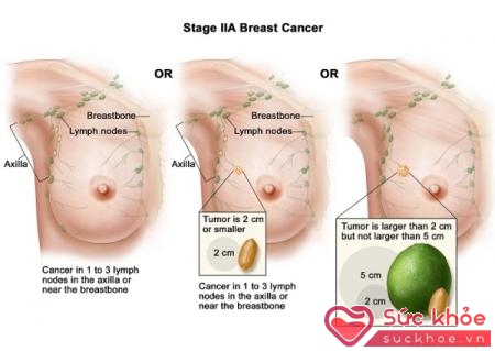 Đặc điểm của ung thư vú giai đoạn 2