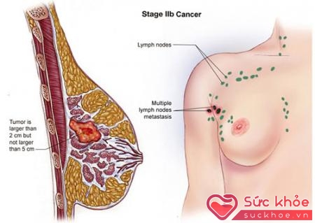 Hách bạch huyết sưng là dấu hiệu ung thư vú giai đoạn đầu
