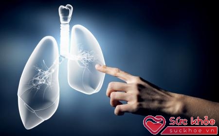 Bệnh phổi mãn tính là một trong những nguyên nhân gây ung thư phổi