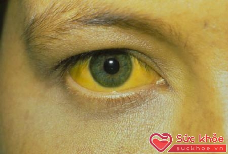 Biến chứng của tiểu đường khá phổ biến ở mắt