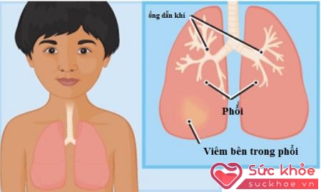 Nguyên nhân gây viêm phổi ở trẻ em khá đa dạng