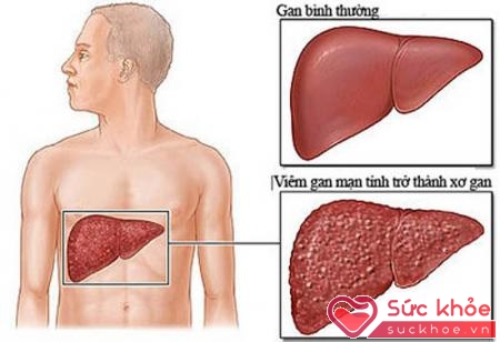 Có một số phương pháp đặc hiệu điều trị viêm gan b mạn