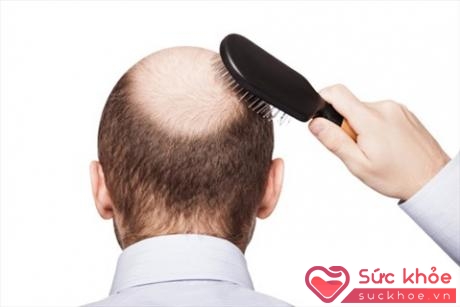 Người bị rụng tóc quá nhiều phải đối mặt với nguy cơ hói đầu (Ảnh minh họa: Internet)