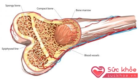 Mắc ung thư máu do rối loạn sinh tủy