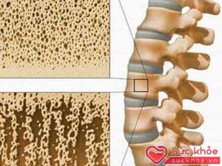Triệu chứng bệnh loãng xương thường được phát hiện khi bệnh đã nặng
