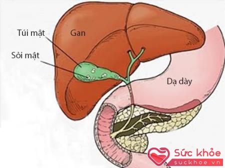 Không có liệu pháp thay thế việc làm mất sỏi mật