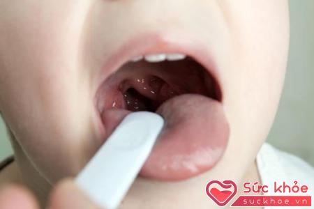 Đau rát họng, khàn tiếng là dấu hiệu ung thư vòm họng giai đoạn đầu