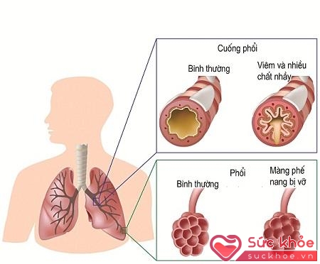 Chứng phế nang là một bệnh nhiễm khuẩn ở phổi.