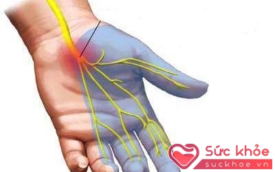 Hội chứng ống cổ tay làm tăng áp lực lên thần kinh giữa vùng cổ tay