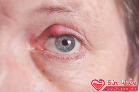 Bệnh zona mắt gây đau rát, đỏ mắt, khó chịu cho người bệnh