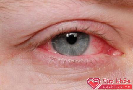 Bệnh zona ở mắt khiến bệnh nhân đau rát mắt