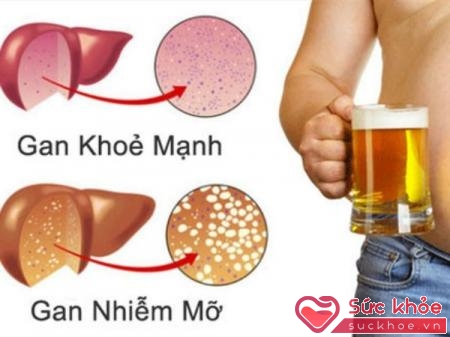 Gan nhiễm mỡ cấp độ 1 là giai đoạn đầu của bệnh gan nhiễm mỡ