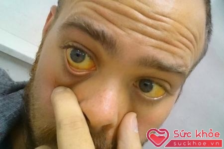 Thiếu máu huyết tán khiến người bệnh bị vàng da, vàng mắt