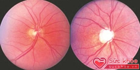 Thị thần kinh bình thường (trái) và thị thần kinh bị tổn thương do glaucoma (phải)