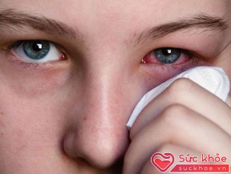 Nguyên nhân gây ra bệnh đua mắt hột có thể do dị ứng, thời tiết, môi trường