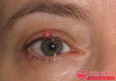 Dấu hiệu đau mắt hột biểu hiện ở kết mạc và giác mạc