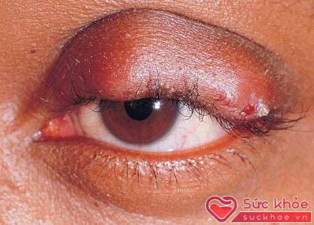 Nguyên nhân bệnh đau mắt hột hình thành ở nữ nhiều hơn nam