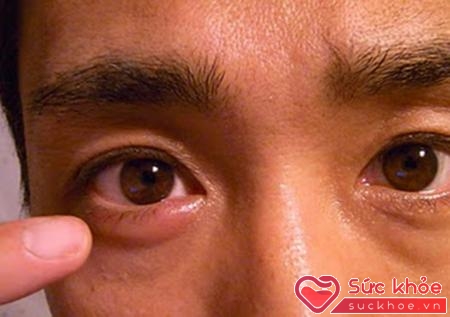 Triệu chứng đau mắt hột biểu hiện ở thể nặng, nhẹ khác nhau