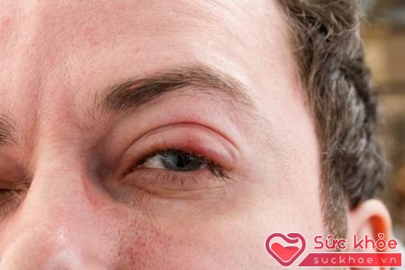 Đau mắt hột thường khởi phát âm thầm
