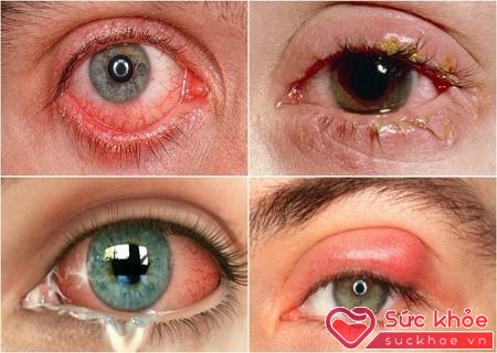 Dấu hiệu bệnh đau mắt hột rất đa dạng