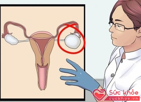 U nang buồng trứng là bệnh lành tính