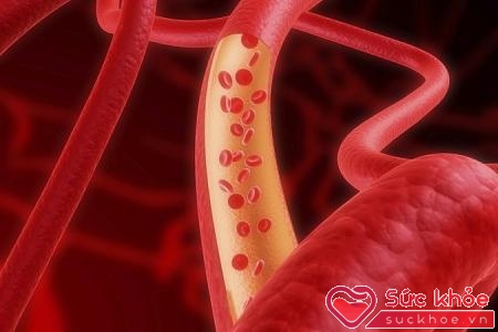 Cholesterol cao gây nên nhiều bệnh có hại cho sức khỏe