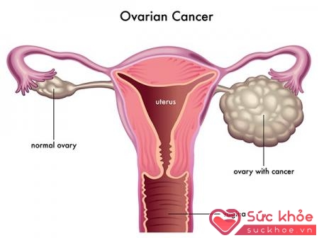 Nguyên nhân gây ra ung thư cổ tử cung rất đa dạng