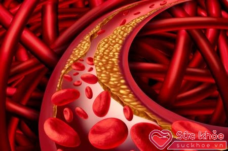 Có rất nhiều nguyên nhân cholesterol trong máu cao