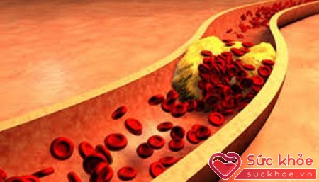 Cholesterol cao là bao nhiêu sẽ cảnh báo bạn có nguy cơ mắc bệnh gì
