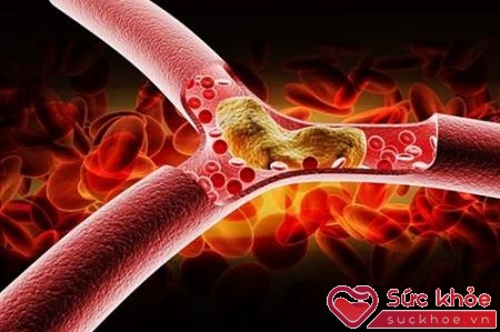 Cholesterol cao gây bệnh gì? Xơ vữa động mạch là câu trả lời