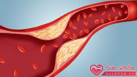 Cholesterol cao là bệnh gì luôn nhận được nhiều sự quan tâm