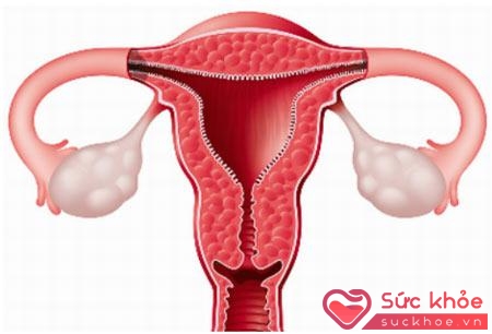 Nguyên nhân dẫn đến viêm cổ tử cung có thể do bệnh lây truyền hay yếu tố vệ sinh vùng kín