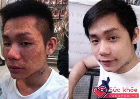 Huy trước (bên phải) và sau khi tiêm trắng với khuôn mặt biến dạng hoàn toàn