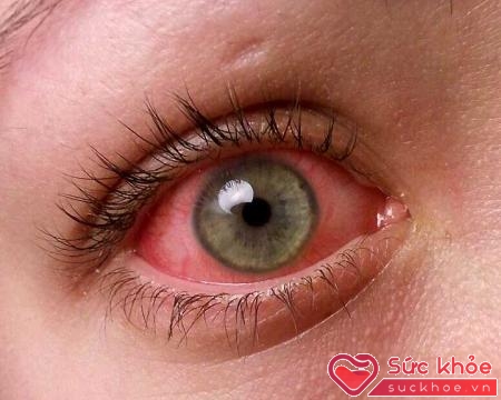 Đau mắt hột biểu hiện qua nhiều giai đoạn