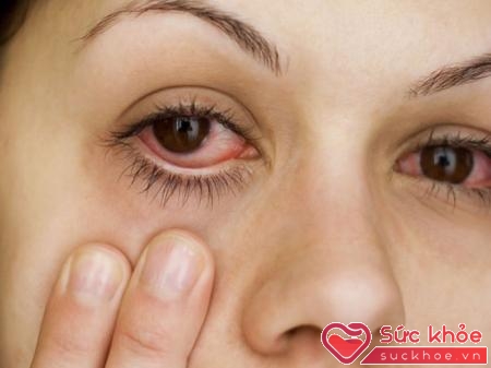 Người bị đau mắt hột thường thấy nhức mắt