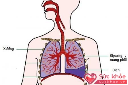 TRàn dịch màng phổi gây nên tình trạng suy hô hấp cấp