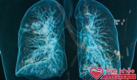 Triệu chứng suy ho hấp cấp làm cho biên độ hô hấp tăng trong hội chứng ARDS, tắc mạch phổi
