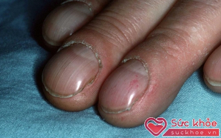 Ngón tay dùi trống là khi ngón trỏ ở nền của móng vượt quá bề dày của khớp liên đốt ngón
