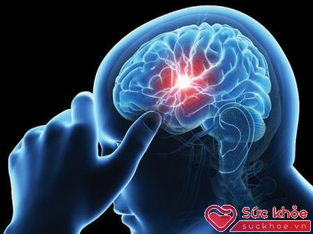 Tai biến mạch máu não là gì? Nhồi máu não là một thể nguy hiểm của bệnh
