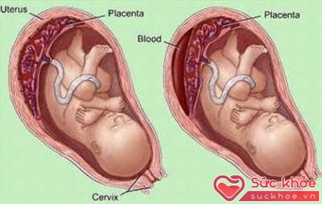  Hình ảnh bong rau non ở bà mẹ mang thai bị sốt xuất huyết.