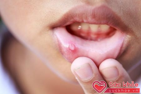 Tổn thương niêm mạc miệng là nguyên nhân nhiệt miệng
