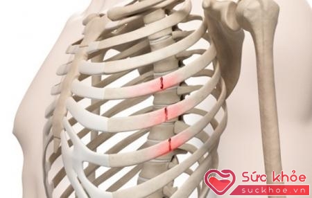 Chấn thương ở lồng ngực hoặc xương sườn cũng có thể gây ảnh hưởng đến quá trình hô hấp.