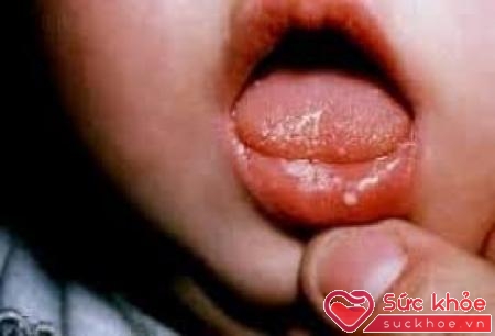Ba mẹ chớ coi thường các triệu chứng nhiệt miệng ở trẻ em