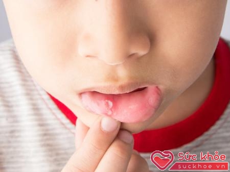 Nhiệt miệng trẻ em là hiện tượng phổ biến