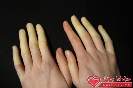 Mức độ suy hô hấp ở giai đoạn 2 này thường làm cho đầu ngón tay bị tím hoặc tái 