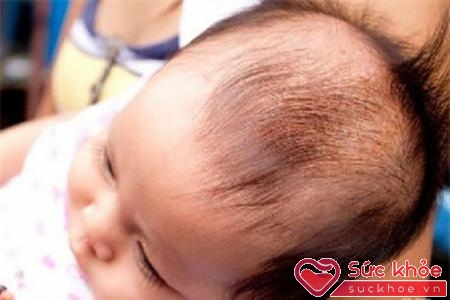 Do dinh dưỡng hay sốt đều khiến bé rụng tóc