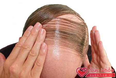 Rụng tóc sau sốt xuất huyết là hiện tượng thường gặp
