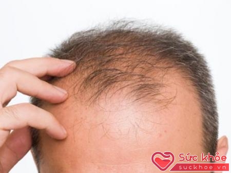 Rụng tóc ở nam giới bắt đầu xuất hiện ừ tuổi 3